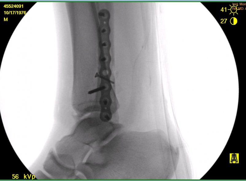 ankle1.jpg