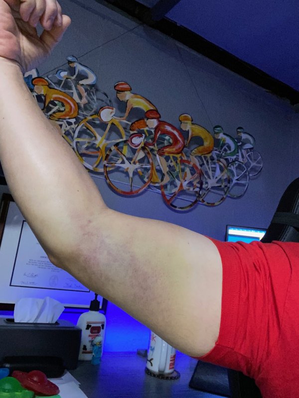 Arm bruise.jpg
