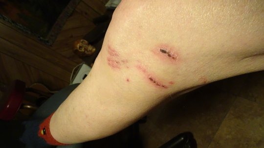 Dog Bite 2 weeks.jpg